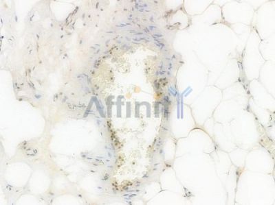 USP10 Recombinant Rabbit mAb - BF3979 at 1/100 staining Human appendiceal carcinoma by IHC-P.