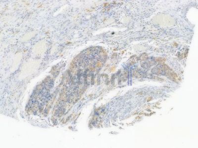 ATP2A2 Recombinant Rabbit mAb - BF3981 at 1/100 staining Human esophageal carcinoma by IHC-P.