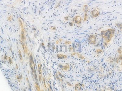 beta IV Tubulin Recombinant Rabbit mAb - BF3983 at 1/100 staining Human intestinal carcinoma by IHC-P.