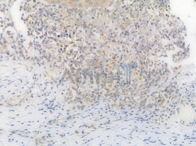 PHB2 Recombinant Rabbit mAb - BF3996 at 1/100 staining Human esophageal carcinoma by IHC-P.