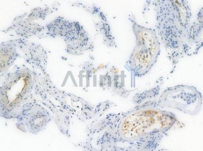 MEK1/2 Recombinant Rabbit mAb - BF3998 at 1/100 staining Human testicular carcinoma by IHC-P.