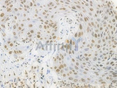 Histone H1.3 Recombinant Rabbit mAb - BF3999 at 1/100 staining Human esophageal carcinoma by IHC-P.