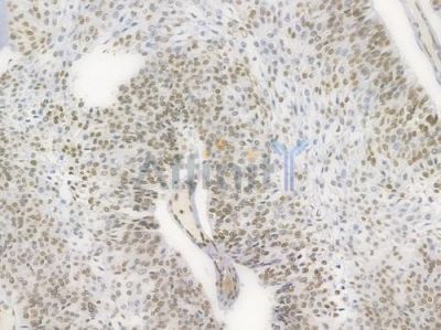 Histone H1.3 Recombinant Rabbit mAb - BF3999 at 1/100 staining Human renal carcinoma by IHC-P.