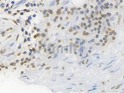 Histone H1.3 Recombinant Rabbit mAb - BF3999 at 1/100 staining Human gastric carcinoma by IHC-P.