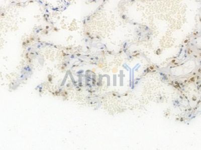 Histone H1.3 Recombinant Rabbit mAb - BF3999 at 1/100 staining Human lung carcinoma by IHC-P.