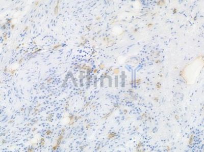 CD36 Recombinant Rabbit mAb - BF4000 at 1/100 staining Human gastric carcinoma by IHC-P.