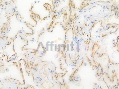 CD36 Recombinant Rabbit mAb - BF4000 at 1/100 staining Human lung carcinoma by IHC-P.