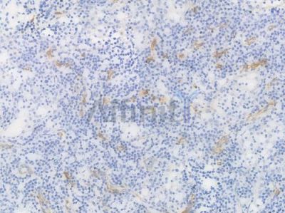 CD36 Recombinant Rabbit mAb - BF4000 at 1/100 staining Human lymph node carcinoma by IHC-P.