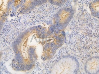 IFITM1 Recombinant Rabbit mAb - BF4005 at 1/100 staining Human intestinal carcinoma by IHC-P.