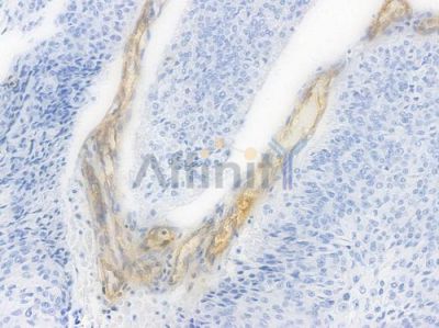 IFITM1 Recombinant Rabbit mAb - BF4005 at 1/100 staining Human renal carcinoma by IHC-P.