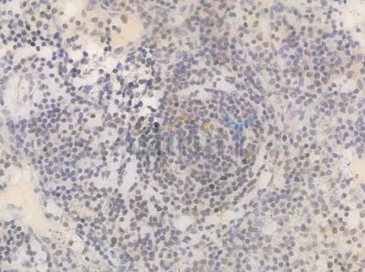 UCHL5 Recombinant Rabbit mAb - BF4006 at 1/100 staining Human lymph node carcinoma by IHC-P.