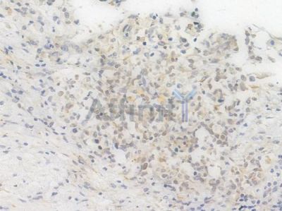 RANGAP1 Recombinant Rabbit mAb - BF4009 at 1/100 staining Human esophageal carcinoma by IHC-P.