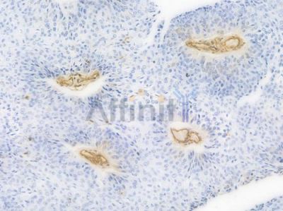 MSN Recombinant Rabbit mAb - BF4015 at 1/100 staining Human renal carcinoma by IHC-P.