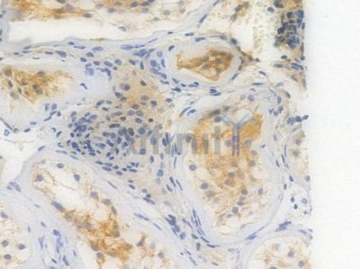 THBS1 Recombinant Rabbit mAb - BF4020 at 1/100 staining Human testicular carcinoma by IHC-P.