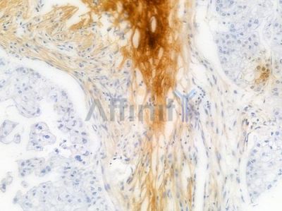 THBS1 Recombinant Rabbit mAb - BF4020 at 1/100 staining Human pancreatic carcinoma by IHC-P.