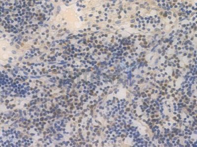 Caspase 3 Recombinant Rabbit mAb - BF4026 at 1/100 staining Human lymph node carcinoma by IHC-P.