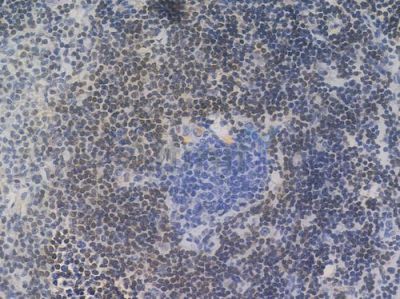 Bcl-2 Recombinant Rabbit mAb - BF4028 at 1/100 staining Human lymph node carcinoma by IHC-P.