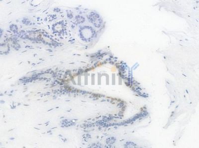 c-Jun Recombinant Rabbit mAb - BF4030 at 1/100 staining Human breast carcinoma by IHC-P.