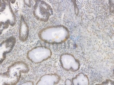 RBBP4 Recombinant Rabbit mAb - BF4032 at 1/100 staining Human intestinal carcinoma by IHC-P.