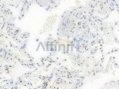 RBBP4 Recombinant Rabbit mAb - BF4032 at 1/100 staining Human lung carcinoma by IHC-P.