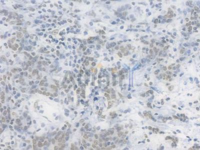 RBBP4 Recombinant Rabbit mAb - BF4032 at 1/100 staining Human gastric carcinoma by IHC-P.
