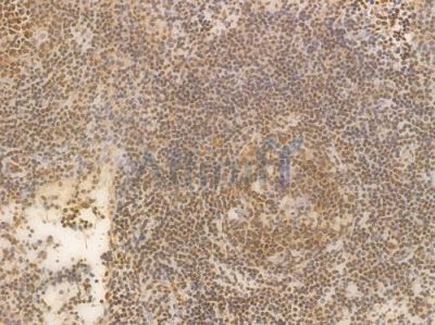 HMGB1 Recombinant Rabbit mAb - BF4033 at 1/100 staining Human lymph node carcinoma by IHC-P.