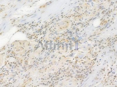 HMGB1 Recombinant Rabbit mAb - BF4033 at 1/100 staining Human gastric carcinoma by IHC-P.