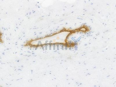Phospho-GSK3 beta (Ser9) Recombinant Rabbit mAb - BF4036 at 1/100 staining Human breast carcinoma by IHC-P.