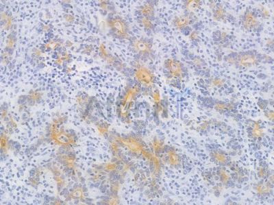 Phospho-GSK3 beta (Ser9) Recombinant Rabbit mAb - BF4036 at 1/100 staining Human gastric carcinoma by IHC-P.