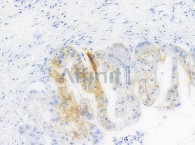 Phospho-GSK3 beta (Ser9) Recombinant Rabbit mAb - BF4036 at 1/100 staining Human pancreatic carcinoma by IHC-P.