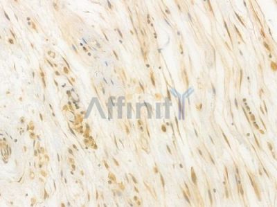 STAT3 Recombinant Rabbit mAb - BF4037 at 1/100 staining Human esophageal carcinoma by IHC-P.
