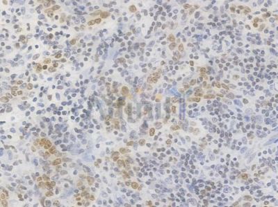 Ki67 Recombinant Rabbit mAb - BF4039 at 1/100 staining Human gastric carcinoma by IHC-P.