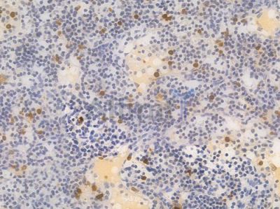 HIF1A Recombinant Rabbit mAb - BF4040 at 1/100 staining Human lymph node carcinoma by IHC-P.