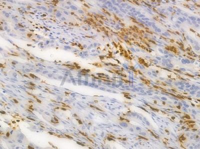 HIF1A Recombinant Rabbit mAb - BF4040 at 1/100 staining Human intestinal carcinoma by IHC-P.