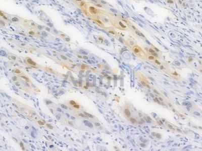 Cyclin D1 Recombinant Rabbit mAb - BF4042 at 1/100 staining Human intestinal carcinoma by IHC-P.