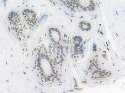 Histone H3 Recombinant Rabbit mAb - BF4048 at 1/100 staining Human breast carcinoma by IHC-P.