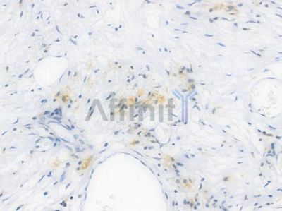 BCL-XL Recombinant Rabbit mAb - BF4049 at 1/100 staining Human esophageal carcinoma by IHC-P.