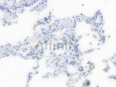 BCL-XL Recombinant Rabbit mAb - BF4049 at 1/100 staining Human breast carcinoma by IHC-P.