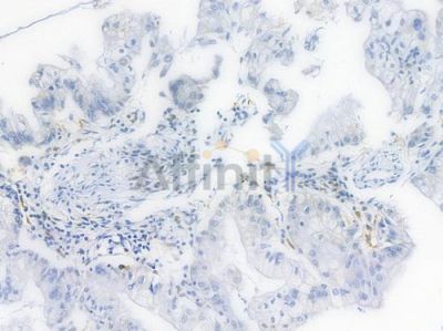 BCL-XL Recombinant Rabbit mAb - BF4049 at 1/100 staining Human pancreatic carcinoma by IHC-P.