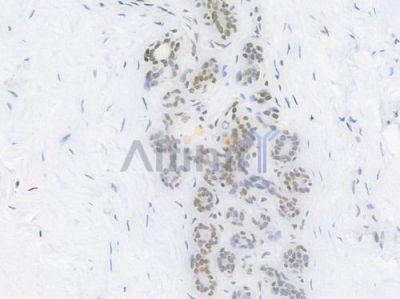 TriMethyl-Histone H3 (Lys27) Recombinant Rabbit mAb - BF4054 at 1/100 staining Human breast carcinoma by IHC-P.