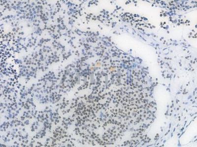 TriMethyl-Histone H3 (Lys27) Recombinant Rabbit mAb - BF4054 at 1/100 staining Human lymph node carcinoma by IHC-P.