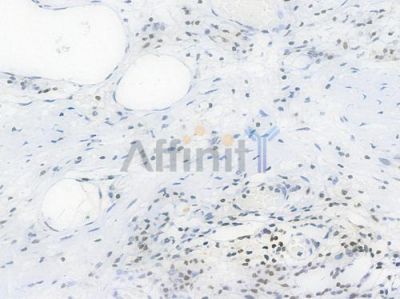TriMethyl-Histone H3 (Lys27) Recombinant Rabbit mAb - BF4054 at 1/100 staining Human esophageal carcinoma by IHC-P.