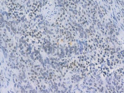 TriMethyl-Histone H3 (Lys27) Recombinant Rabbit mAb - BF4054 at 1/100 staining Human gastric carcinoma by IHC-P.