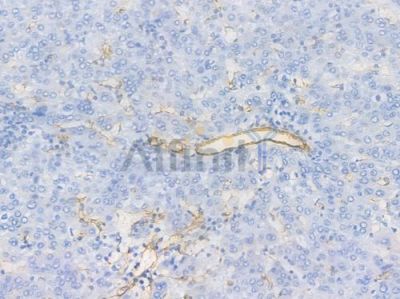 CD31 Recombinant Rabbit mAb - BF3031 at 1/100 staining Human liver carcinoma by IHC-P.