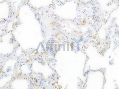 CD31 Recombinant Rabbit mAb - BF3031 at 1/100 staining Human lung carcinoma by IHC-P.