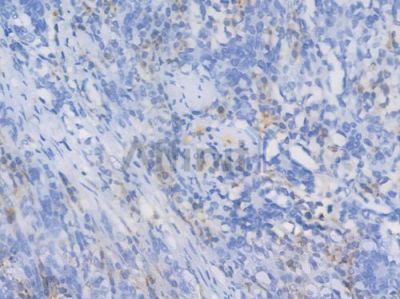 CD31 Recombinant Rabbit mAb - BF3031 at 1/100 staining Human gastric carcinoma by IHC-P.