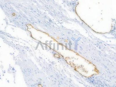 CD31 Recombinant Rabbit mAb - BF3031 at 1/100 staining Human renal carcinoma by IHC-P.