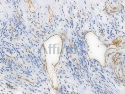 CD31 Recombinant Rabbit mAb - BF3031 at 1/100 staining Human intestinal carcinoma by IHC-P.