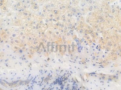 IL1RN Recombinant Rabbit mAb - BF4409 at 1/100 staining Human lung carcinoma by IHC-P.
