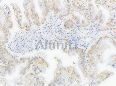 GCN5L2 Recombinant Rabbit mAb - BF4418 at 1/100 staining Human pancreatic carcinoma by IHC-P.